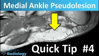 Foot medial pseudolesion on MRI  MSK Quick tip 4 SHORT [upl. by Phonsa]