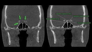 Detecting signs of Type II Diabetes Mellitus on CBCT Xray Images [upl. by Anilak]