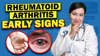 Early Warning Signs Of Rheumatoid Arthritis  Dont Ignore These Vital Symptoms [upl. by Lever]