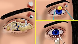 💟 ASMR ☮️ Eye Brow Piercing Removal Surgery UNHYGENIC Pus Treatment Eye Squeeze Acne Animation [upl. by Ylatfen]