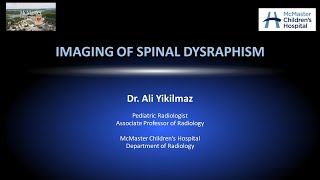 Spinal Dysraphism [upl. by Stevens256]