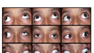 Evaluation of Restrictive Strabismus [upl. by Eirolam476]