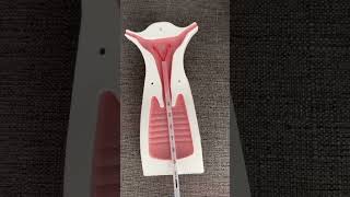 Copper t Online Simulation  IUD Procedure quot What is the Usesquot [upl. by Carberry]