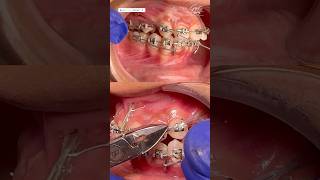 Dental Braces Treatment in India  Aligner  Invisalign  Before and After Results aligner braces [upl. by Phalan]