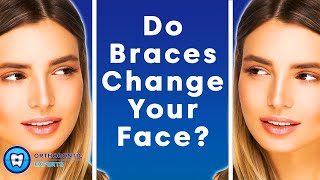 Do Braces Change Your Face  The Impact Of Braces On Your Jawline amp Face Shape [upl. by Noynek]