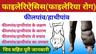 फाइलेरिऐसिस फाइलेरिया रोग  filaria ke lakshan  filariasis  elephantiasis  फीलपांव  हाथीपांव [upl. by Keane]