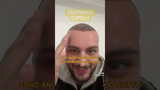 Prurito lozioni e gonfiore dopo il trapianto di capelli come gestirli 💆‍♂️ [upl. by Selim250]