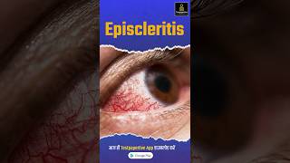 What is Episcleritis  Ophthalmology  eye ophthalmology episcleritis eye peramedical [upl. by Aihsyak]