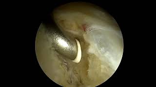 Arthroscopic Pincer Resection Utilizing an Outside In Approach for Intra articular Access [upl. by Hamitaf533]