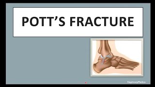 Potts Fracture  Orthopaedics  Rapid Revision  USMLE [upl. by Birkner794]