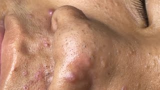 ACNE TREATMENT VU QUYNH MI  Blackheads Chin amp Nose Of Tweens 2024 EX [upl. by Zebadiah]