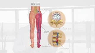 Sciatalgie expliquée par le Dr Yves Bélanger chiropraticien [upl. by Placido]