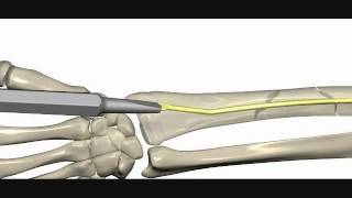 RIN Radius İntramedüller Çivi Radius Intramedullary Nail [upl. by Amber337]