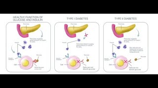 Differences between the Clinical features of Diabetes mellitus Type 1 and Type 2 [upl. by Euqnom]