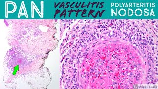 Polyarteritis nodosa amp leukocytoclastic vasculitis pattern Inflammatory Dermpath Basics [upl. by Aiekal]