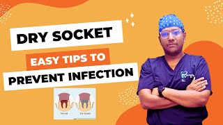 Dr Rudra Mohan  Understanding Dry Socket Causes Symptoms and Prevention Extraction Socket Pain [upl. by Raviv]