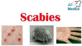 Scabies Skin Condition  What Is It Classic vs Crusted Types Signs amp Symptoms Treatment [upl. by Lazaro]