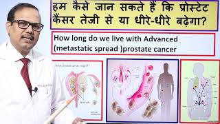 Survival in advance prostate cancer DrProfSantosh Kumar PGI [upl. by Woodall]