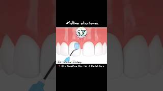 gapping between teethmidline Diastema closure painless cureshortsfeed midlinediastemaclosure [upl. by Brice]