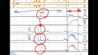 how to interpret cystometry urodynamics [upl. by Gluck502]