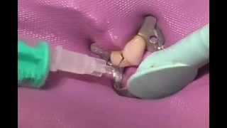 How the root canal is desinfected  Sodium Hypochlorite [upl. by Reaht]