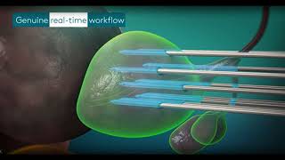 Brachytherapy in Prostate Cancer [upl. by Sephira]