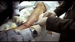 Worst Ankle Fracture Part 2  Bizarre ER [upl. by Grantley]