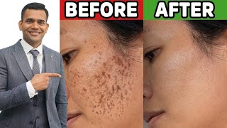 Magical Home Remedy To Treat Melasma Dark Spot and Pigmentation [upl. by Zurn277]