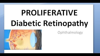 Ophthalmology 285 PDR Proliferative Diabetic Retinopathy Maculopathy Advanced eye disease Tractional [upl. by Neerihs]