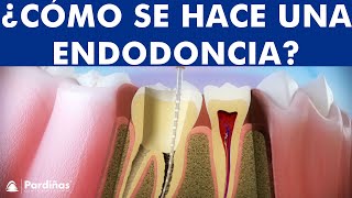 ¿Qué es una Endodoncia  Tratamiento de conductos o desvitalización del diente paso a paso © [upl. by Montague]