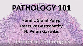 Fundic Gland Polyp Reactive Gastropathy and H Pylori gastritis  Pathology 101 GI Pathology [upl. by Sosthina]