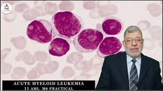 Acute Myeloid Leukemia 11 AML amp M6 Practical [upl. by Skippie596]