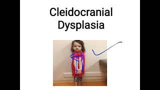 cleidocranial dysplasia [upl. by Ymmac996]