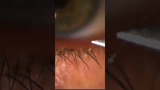 Eyelid Mite Infestation Demodex [upl. by Consuelo]