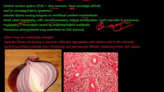 92P Morphology of Systemic lupus erythematosus SLE part 3 [upl. by Ydolem]