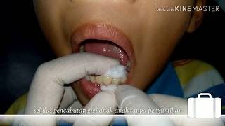 Pencabutan Gigi AnakPencabutan Gigi GoyangTooth Extraction [upl. by Candace]