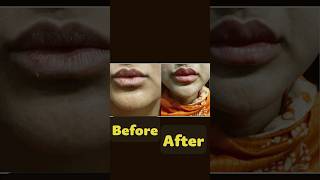 You MUST Watch  💋Lip Filler Injection for Fuller Plump Lips [upl. by Gerrie]