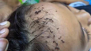 How to remove all hundred lice from her hair  Remove all hundred lice from her long hair [upl. by Eniarral666]