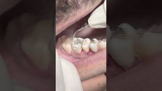 Scaling and cleaning tartar amp calculus dentistteeth dentist satisfying [upl. by Anaidiriv521]