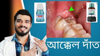 আক্কেল দাঁত নিয়ে সকল সমস্যার সমাধান  How to prevent Wisdom Teeth problem [upl. by Mika]