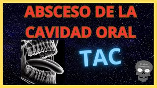 ABSCESO de la cavidad ORAL👉Hallazgos Radiológicos [upl. by Edgard]