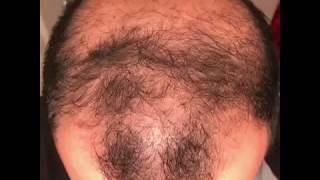 6 months using minoxidil  Rogaine 5 Before amp After results [upl. by Beacham839]