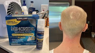 KIRKLAND SIGNATURE MINOXIDIL 5 FOAM 7 MONTH REVIEW AND HOW TO USE DEMO FOR HAIR REGROWTH TREATMENT [upl. by Etnovert536]