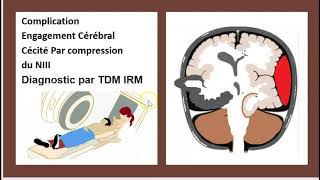 Comment diagnostiquer une HTIC  Syndrome dHypertension Intracrânienne Hernie cérébrale 3 Minutes [upl. by Phillip352]