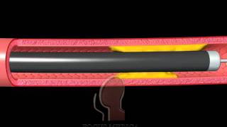 Laser angioplasty [upl. by Chellman]