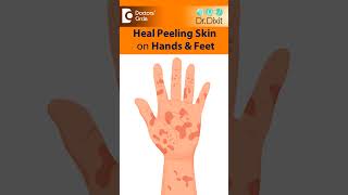 SKIN PEELING from Hand amp FeetIs it Eczema PsoriasisFungusDrRasya DixitDoctors Circle shorts [upl. by Amlas]