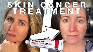 Chantelles Fluorouracil Skin Cancer Treatment  Skin Deep [upl. by Atinyl]