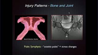 Imaging of Groin Pain Athletic Pubalgia [upl. by Genevra961]