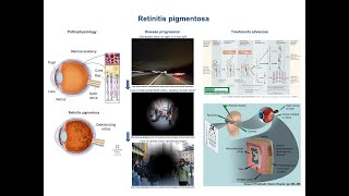 Retinitis pigmentosa pathophysiology and treatment advances [upl. by Abe]