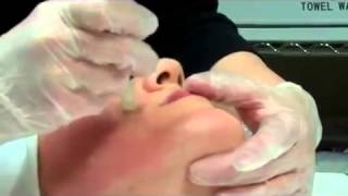 Dermapen Micro Needling Treatment [upl. by Ottinger]